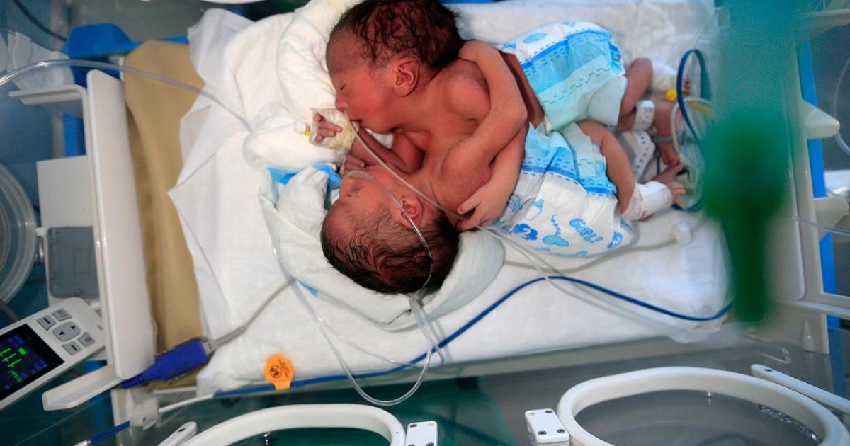 Conjoined Yemeni twins need life-saving surgery abroad