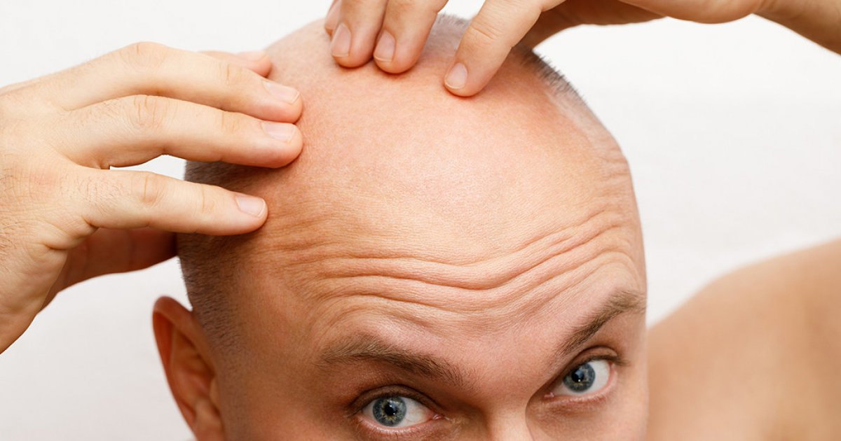 Calling A Man Bald Is Sexual Harassment Uk Court Rules 