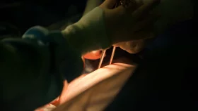 Report: Caesarean delivery increases at abnormal rate, especially in private hospitals