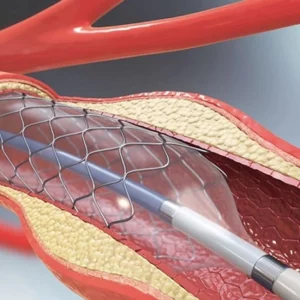 DGDA revises cardiac stent prices