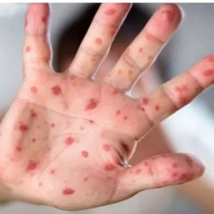 Measles outbreak: Four deaths, 1170 suspected cases in 24 hours