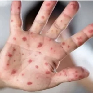 Measles and the classroom