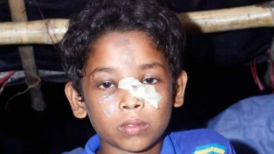 Anas was shot in his nose, arm and leg by the Myanmar army who thought him dead | Focus Bangla