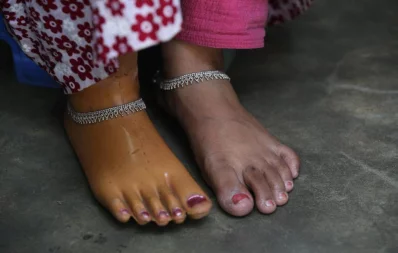 A worker shows her prosthetic leg as her right leg was crushed in the Rana Plaza factory disaster  Syed Zakir Hossain/Dhaka Tribune