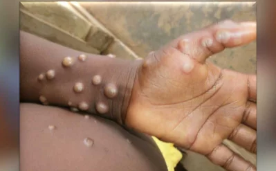 A human case of mpox (Image obtained from WHO site/Credit: Nigeria Centre for Disease Control)