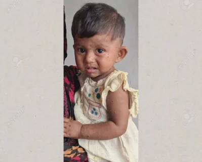 Measles patients at the Infectious Diseases Hospital in Mohakhali.