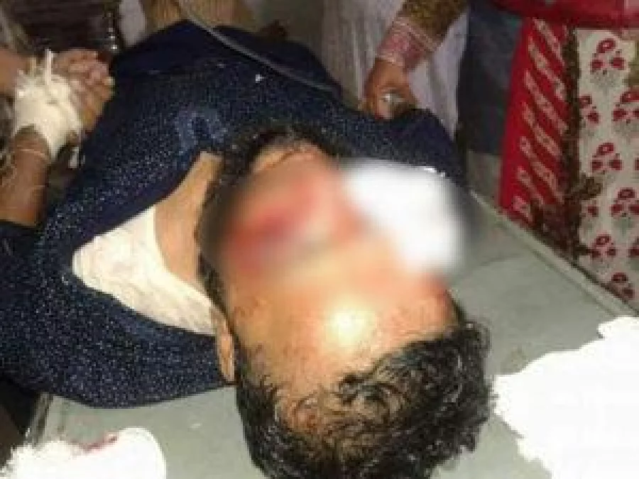 Siddiqur underwent surgery on both of his eyes on the morning of July 22 and is currently being treated at National Eye Science Institute Hospital Courtesy