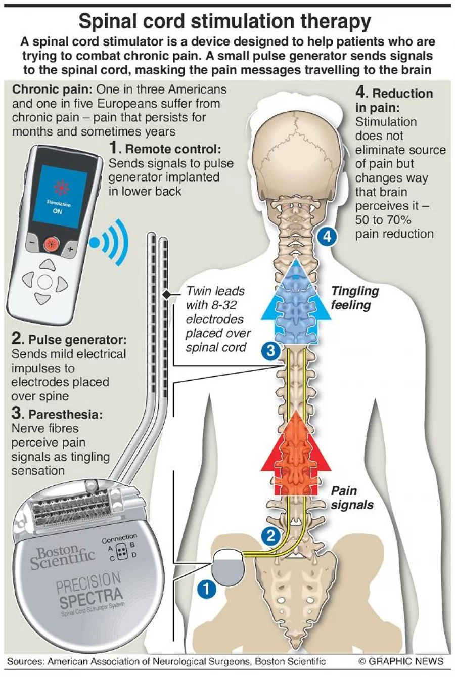 Image 14373: Spinal Cord Stimulator Illustration